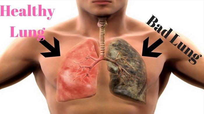 Jangan Anggap Sepele, Ini 6 Tanda Paru-paru tak Sehat