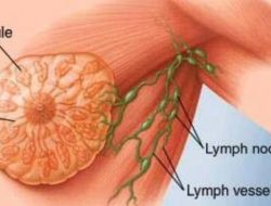 Marshanda Idap Tumor Payudara dan Minta Didoakan Sembuh, Ini Perbedaan dengan Kanker Payudara